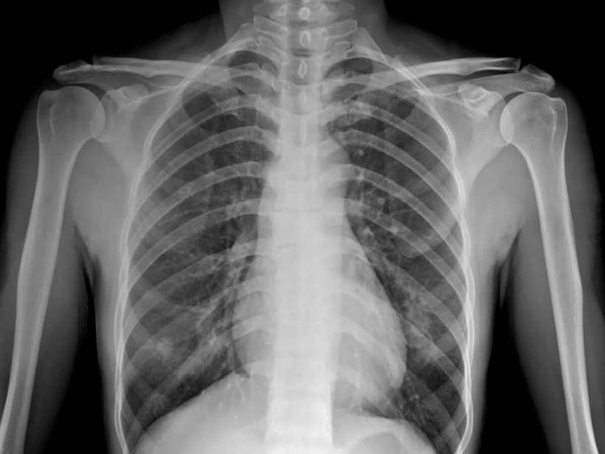 Diagnosticar el coronavirus con radiografías ¿Pueden las radiografías detectar el coronavirus?